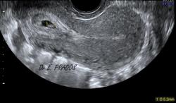 Grossesse Cervicale : Embryon