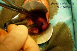 Dilatation du col de l'utérus avant Curetage - Dr E. PRADOS
