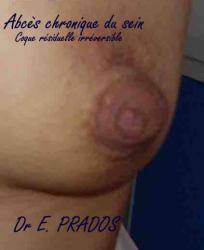 Abcès du sein Chronique - Dr E. PRADOS / Med-sein