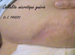 Cellulite sein guérie - Dr E. PRADOS / Med-sein