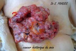 Cancer historique du sein 3 - Dr E. PRADOS / Med-sein